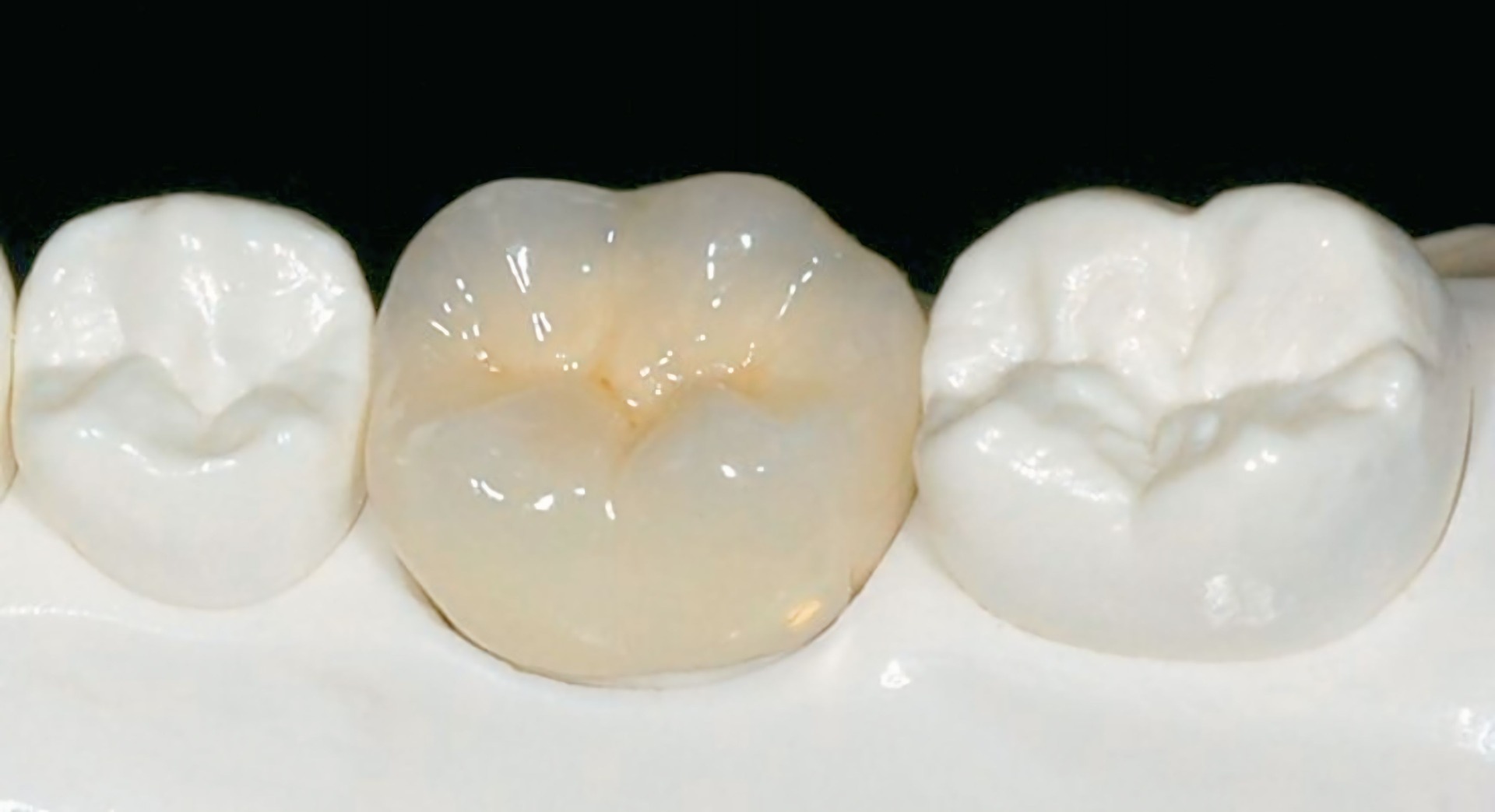 Corona Monolítica Zirconio