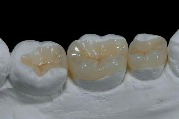Incrustaciones Zirconia
