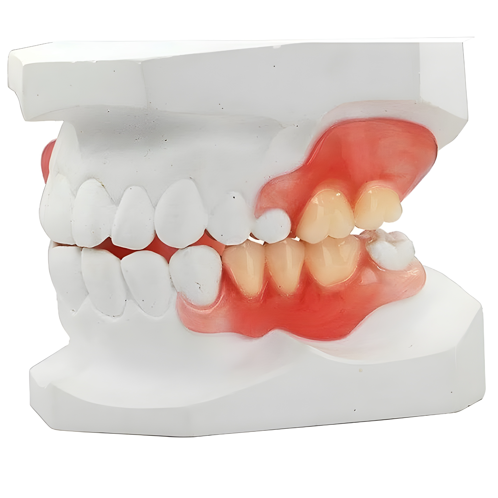 Valplast